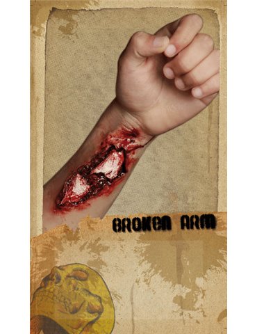 Prosthetic Wounds Broken Arm